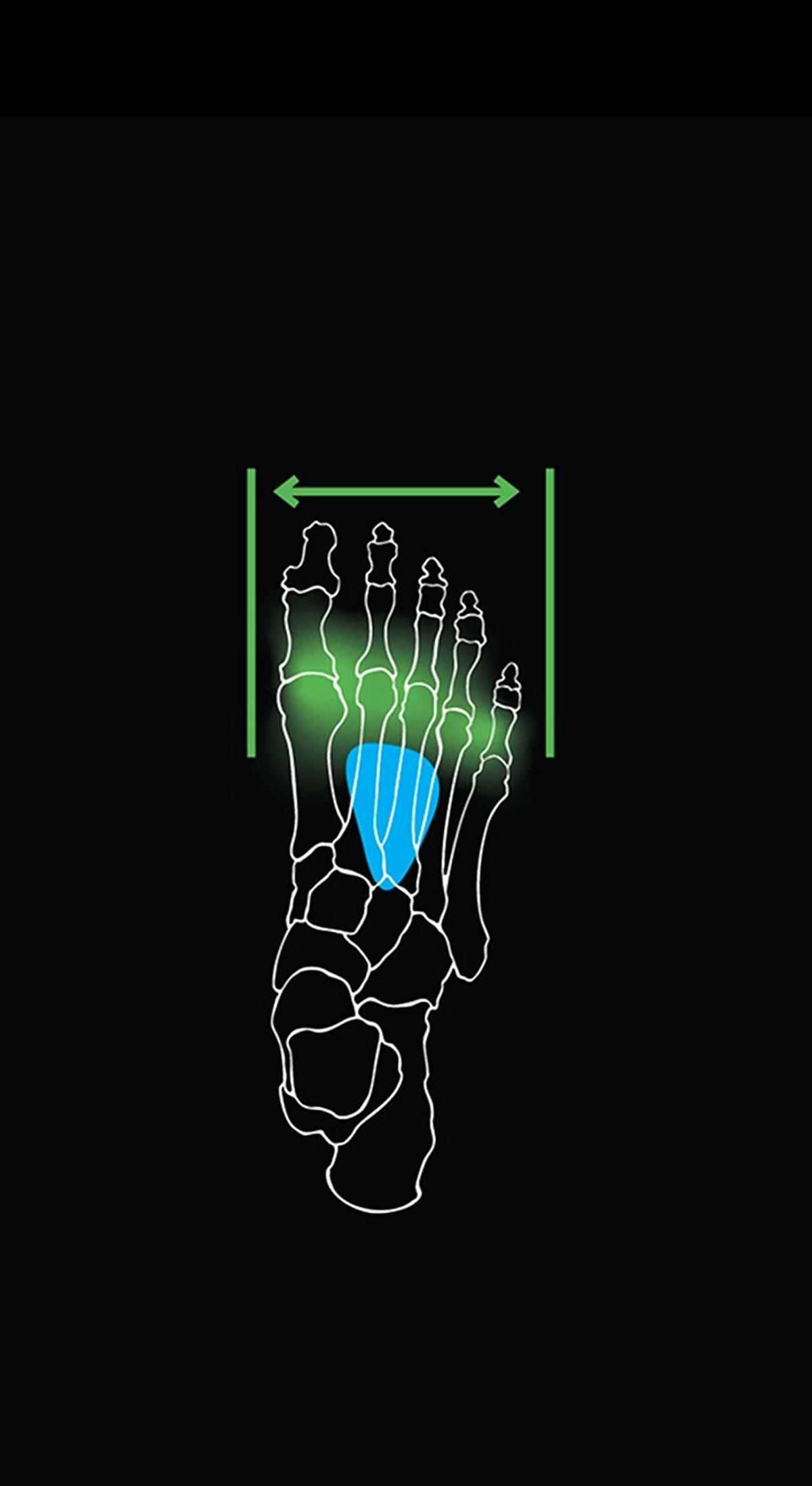 Metatarsal Button